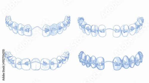 Four illustrations of orthodontic appliances, displaying upper and lower dental arches with braces