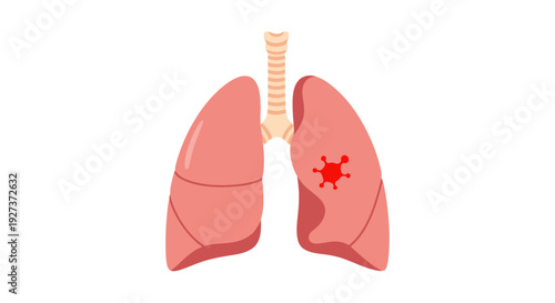 Lung Cancer Flat Vector Illustration with Highlighted Tumor