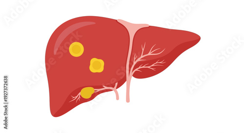 Liver Cancer Medical Flat Vector with Tumor Highlight