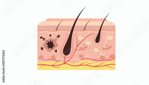 Skin Cancer Melanoma Medical Flat Vector Illustration