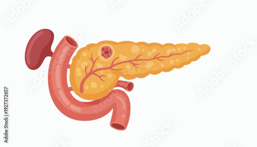 Pancreatic Cancer Medical Flat Vector with Tumor Highlight