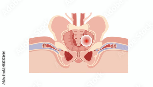 Prostate Cancer Medical Flat Vector Illustration