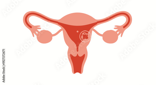 Illustration of the female reproductive system highlighting the risks and awareness of ovarian cancer and related health issues in women