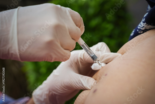 close up doctor is injecting enoxaparin injection to belly with syringe