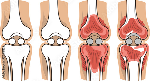Knee anatomy illustration showing healthy and inflamed joint conditions