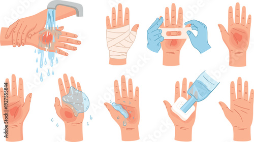 Hand Burn First Aid Treatment Steps Vector Illustration with Running Water Cooling, Sterile Bandaging, Antiseptic Care, and Wound Healing Process Guide