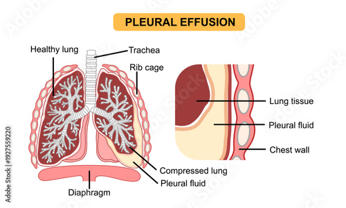 Illustration of pleural effusion, fluid in lung anatomy diagram, fluid accumulation. fluid accumulation in the lung cavity. Vector illustration for medical, respiratory disease, education, and poster.