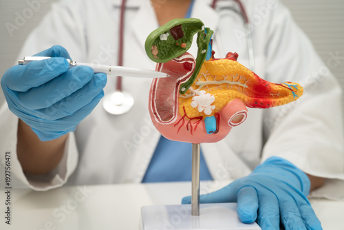 Pancreatitis, pancreatic cancer, Asian doctor with pancreas, gallbladder and bile duct human anatomy model at hospital.