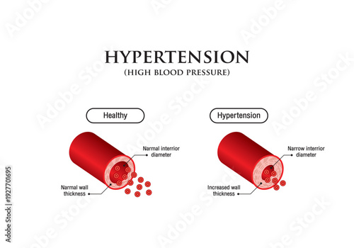 Hypertension. high blood pressure. healthy and vessel with hypertensive. Vasoconstriction. Medical diagram. Vector illustration.