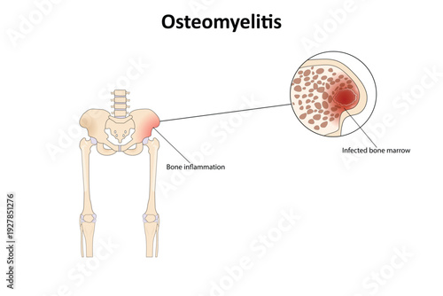 Osteomyelitis vector illustration