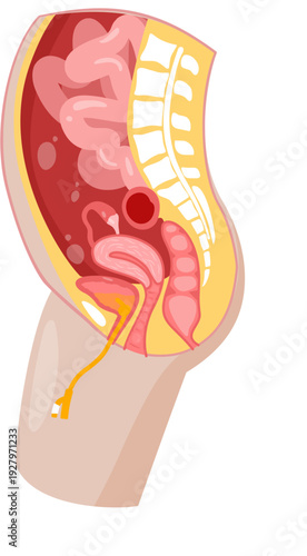 Female Urinary Catheter 