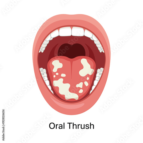 Illustration depicting an open mouth with visible signs of oral thrush infection
