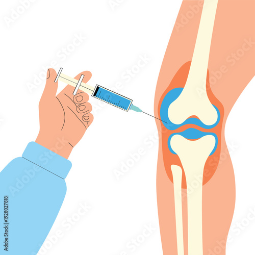 Illustration of a knee joint injection procedure with a syringe and needle