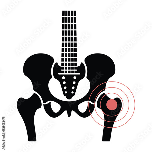 Anatomical illustration showing a guitar shaped pelvis with hip pain highlighted