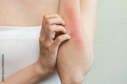 Tableau sur toile Dermatology, asian young woman reaction from atopic, insect bites on her arm, hand in scratching itchy red spot or rash of skin