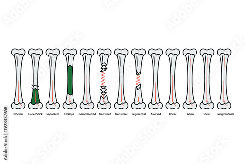 Bone fracture types illustrated in a medical diagram with labels
