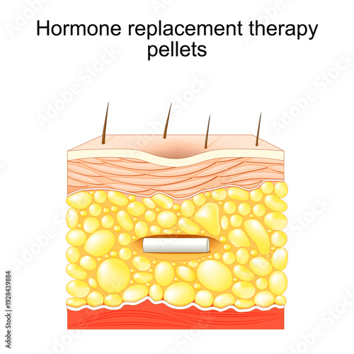 Hormone replacement therapy pellets. skin with Hormonal pellet in fat layer
