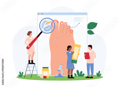 Diagnosis and treatment of onychomycosis, dermatology checkup in hospital, podiatry. Tiny people with magnifying glass detect toe nail infection, skin inflammation cartoon vector illustration
