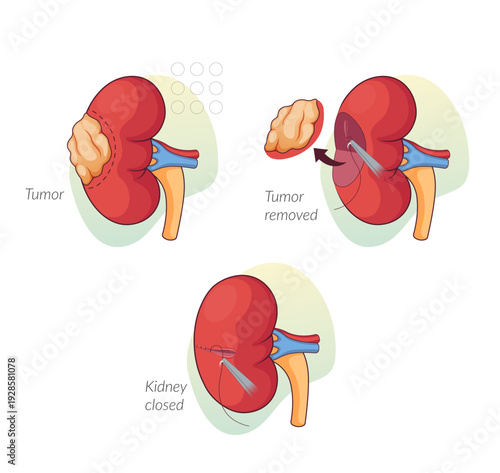 Kidney Tumor Removal Surgical Procedure - Stock Illustration
