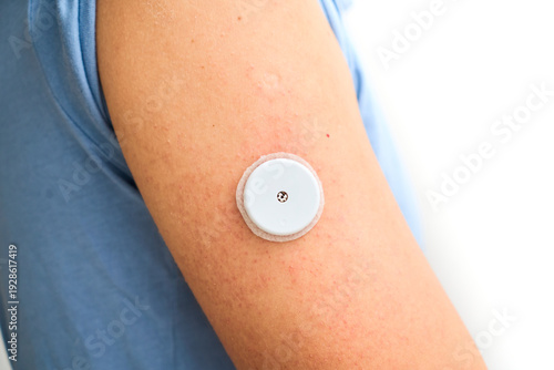 Glucose monitoring sensor on arm for diabetes control