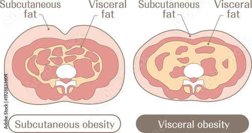 Subcutaneous Fat and Visceral Fat Obesity Types Comparison Illustration