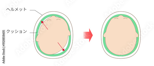 成長誘導による頭蓋矯正、斜頭症に対するヘルメット治療の仕組みを示した図解
