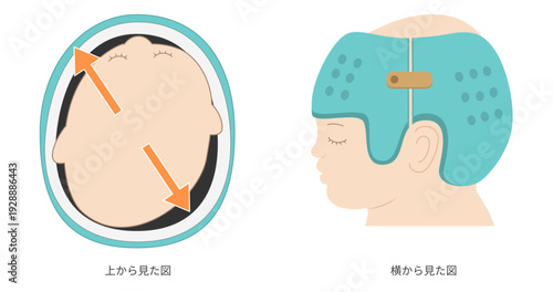 上と横から見た斜頭症に対するヘルメット治療の仕組みを示した図解（成長誘導による頭蓋矯正）
