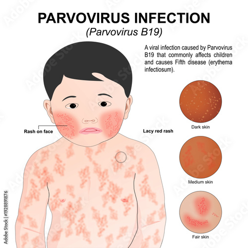 Parvovirus Infection (Parvovirus B19) Flashcard