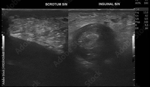Tableau sur toile Scrotal ultrasound with color Doppler evaluation demonstrates features suggestive of inguinoscrotal hernia with associated vascular compromise, raising suspicion for testicular torsion