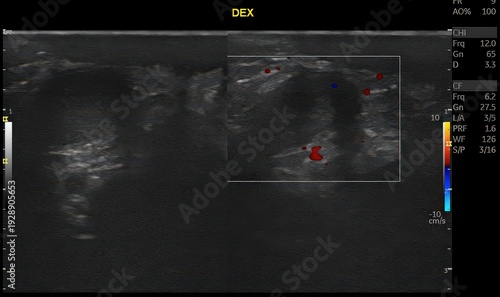 Fotografie Scrotal ultrasound with color Doppler evaluation demonstrates features suggestive of inguinoscrotal hernia with associated vascular compromise, raising suspicion for testicular torsion