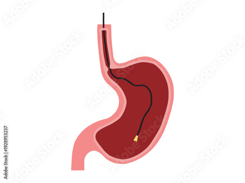 Hand Drawn Endoscopy in Stomach Disease