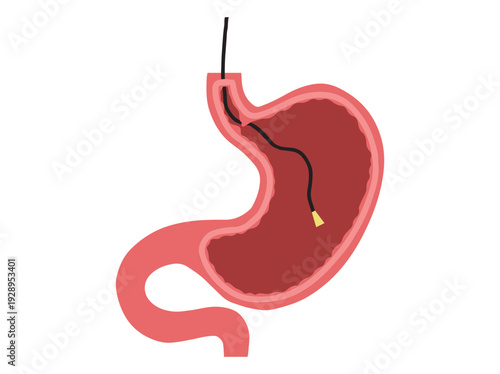Endoscopy in Stomach Disease Clip Art
