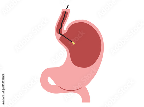 Endoscopy in Stomach Disease Illustration
