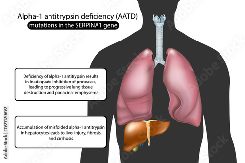 Alpha1 Antitrypsin Deficiency Lung and Liver Pathology Diagram.  Mutations in the SERPINA1 gene. Disease Mechanism Anatomy Illustration