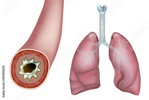 Bronchiectasis and Increased secretion Mucus. Human bronchus in cross section with mucus. Bacterial Infection in the LungsBronchiectasis and Increased secretion Mucus. Human bronchus in cross section 