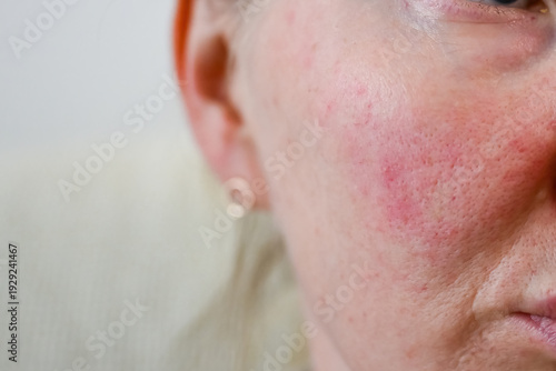 Принти на полотні Red irritated skin with rosacea and visible pores on female cheek close up