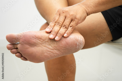Asian woman check feet with crack and dry heel skin, Diabetic Foot.