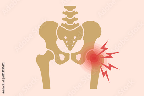 Human skeleton with painful hip joint