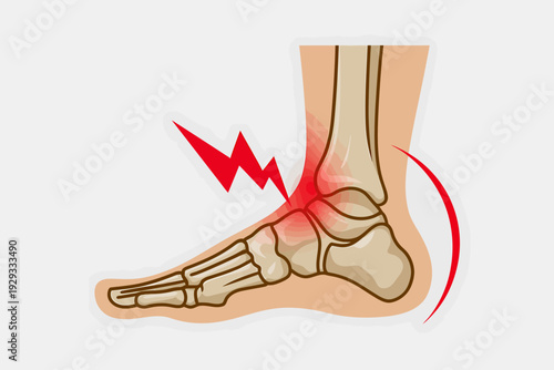 Ankle pain with bones showing