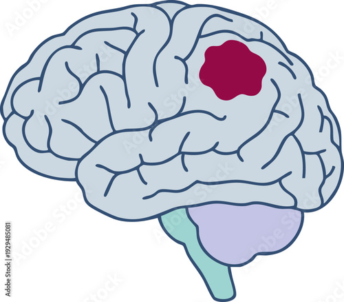 Illustration of a Human Brain with a Highlighted Area Representing a Brain Lesion or Tumor