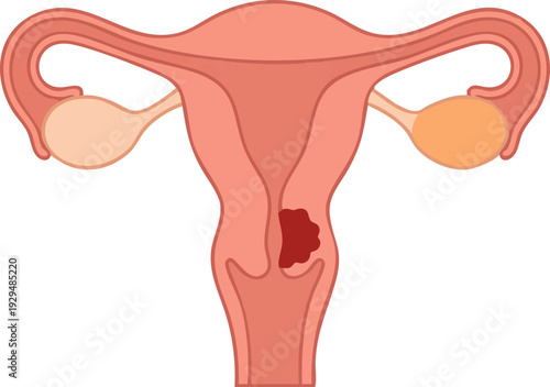 Illustration of the Female Reproductive System featuring the Uterus with a Lesion
