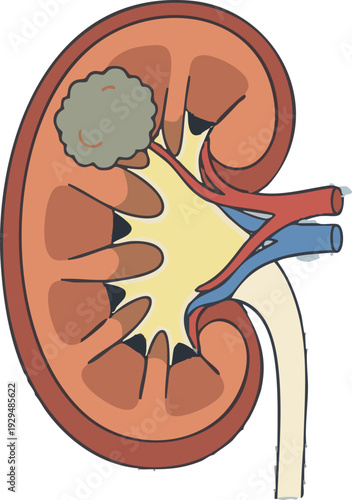 Medical illustration of a human kidney cross-section with an abnormal growth, detailing renal anatomy, kidney disease, and internal organ health challenges