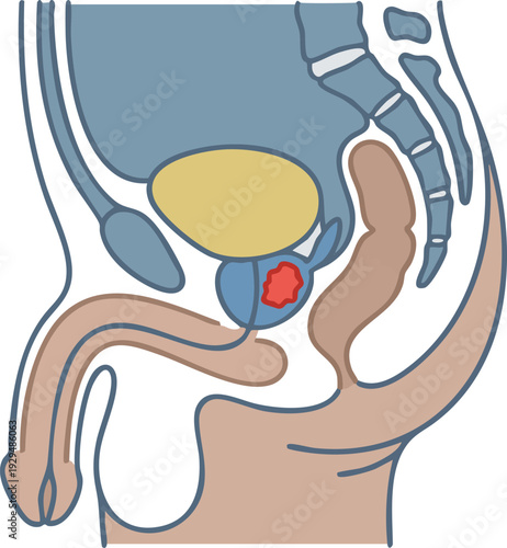Anatomical illustration of the male pelvic region showcasing the prostate gland with a highlighted area representing a potential abnormality or disease