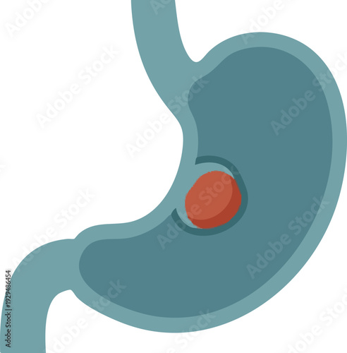 Illustration of a human stomach with a tumor or growth detected inside it, symbolizing health and medical diagnosis