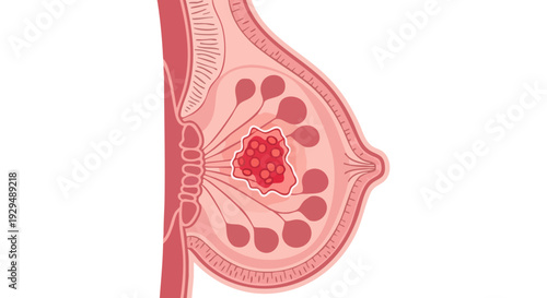 Detailed medical illustration of a cancerous tumor within the human breast, highlighting the importance of early detection and screening for breast health awareness