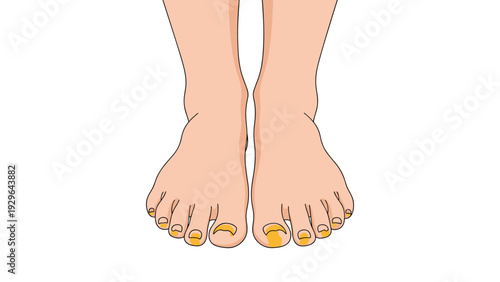 Close up of human feet with yellow and discolored toenails indicating a fungal infection or health issue needing treatment.