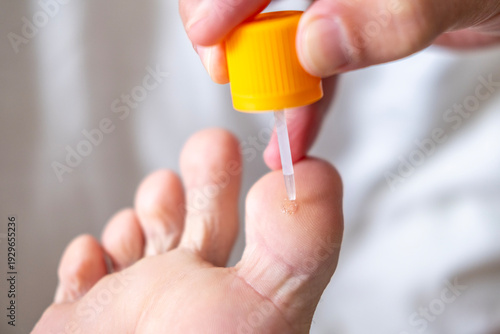 Bild auf Leinwand person's foot receiving topical treatment wart or skin lesion close-up, medical