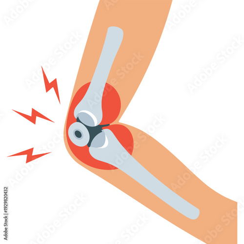An illustration of a painful knee joint with inflamed bones and ligaments