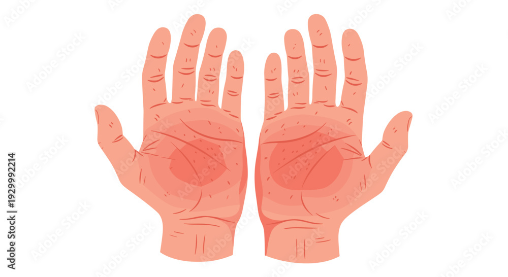 Fototapeta premium Two human palms with red irritated skin and circular rash patterns are shown against a plain white background.