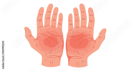Two human palms with red irritated skin and circular rash patterns are shown against a plain white background.
